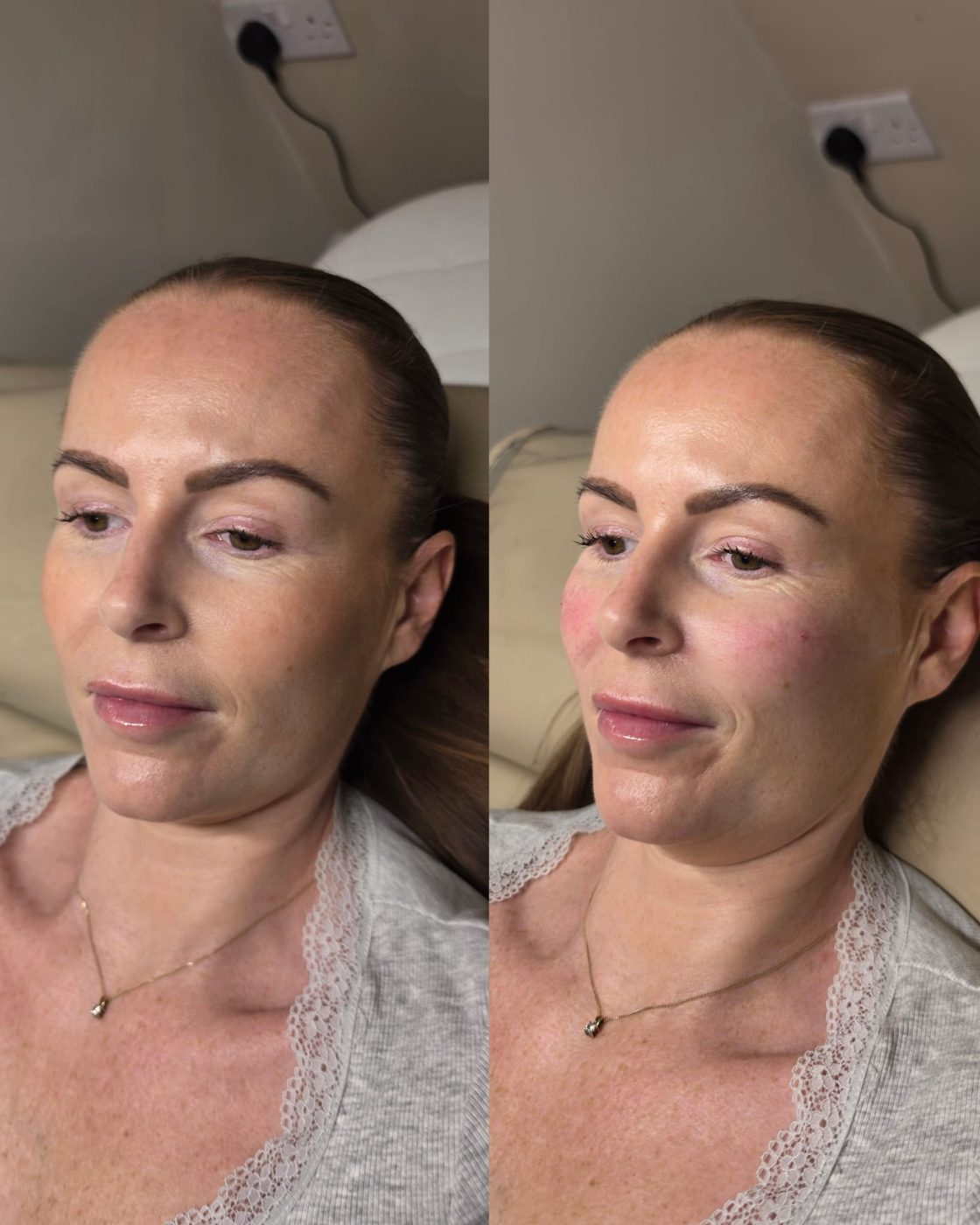 Cheeks before and after dermal filler