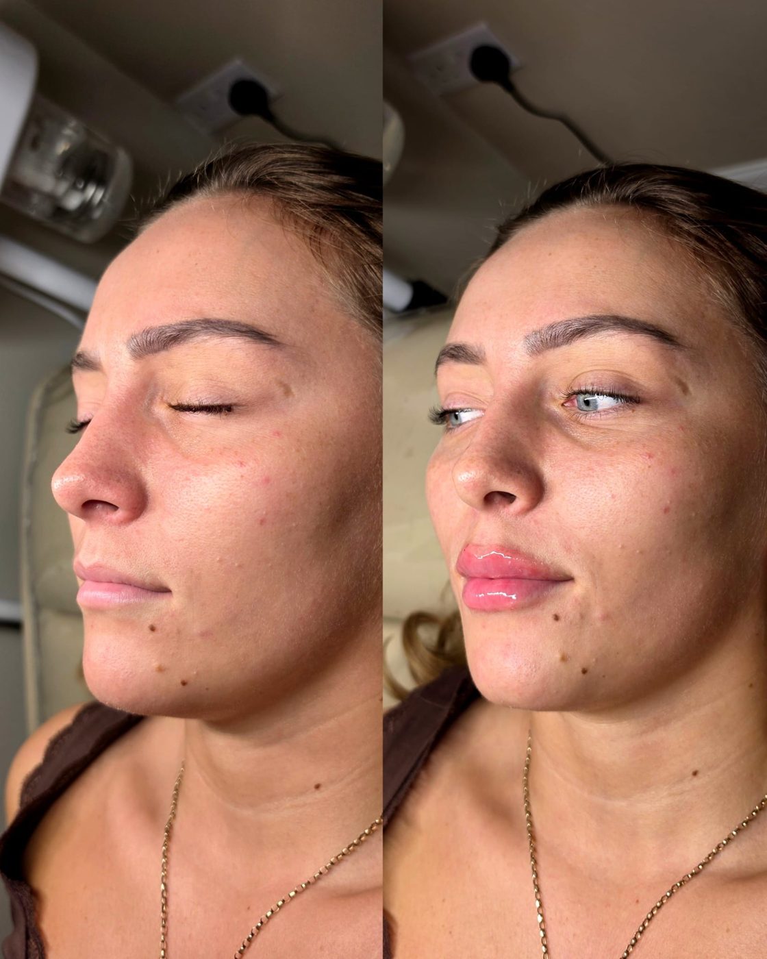 Lips before and after lip filler