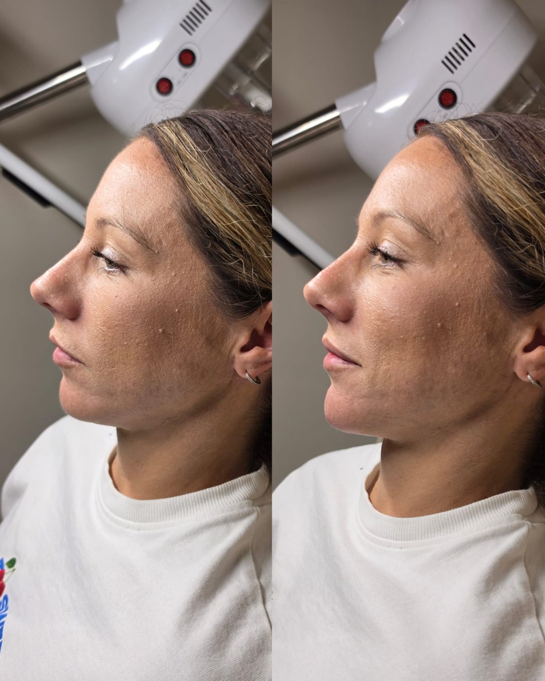 Side profile before and after facial balancing