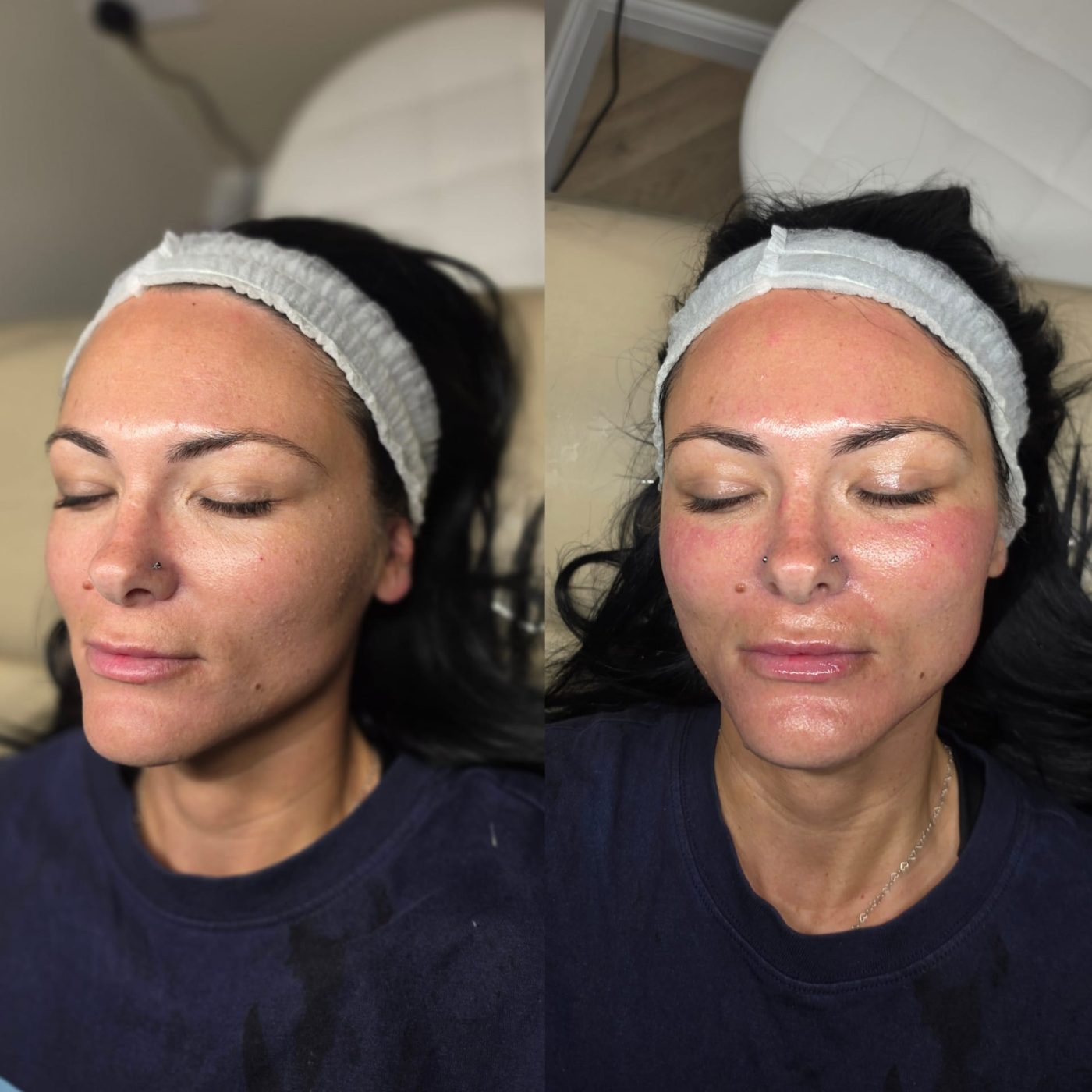 Skin before and straight after a skin treatment