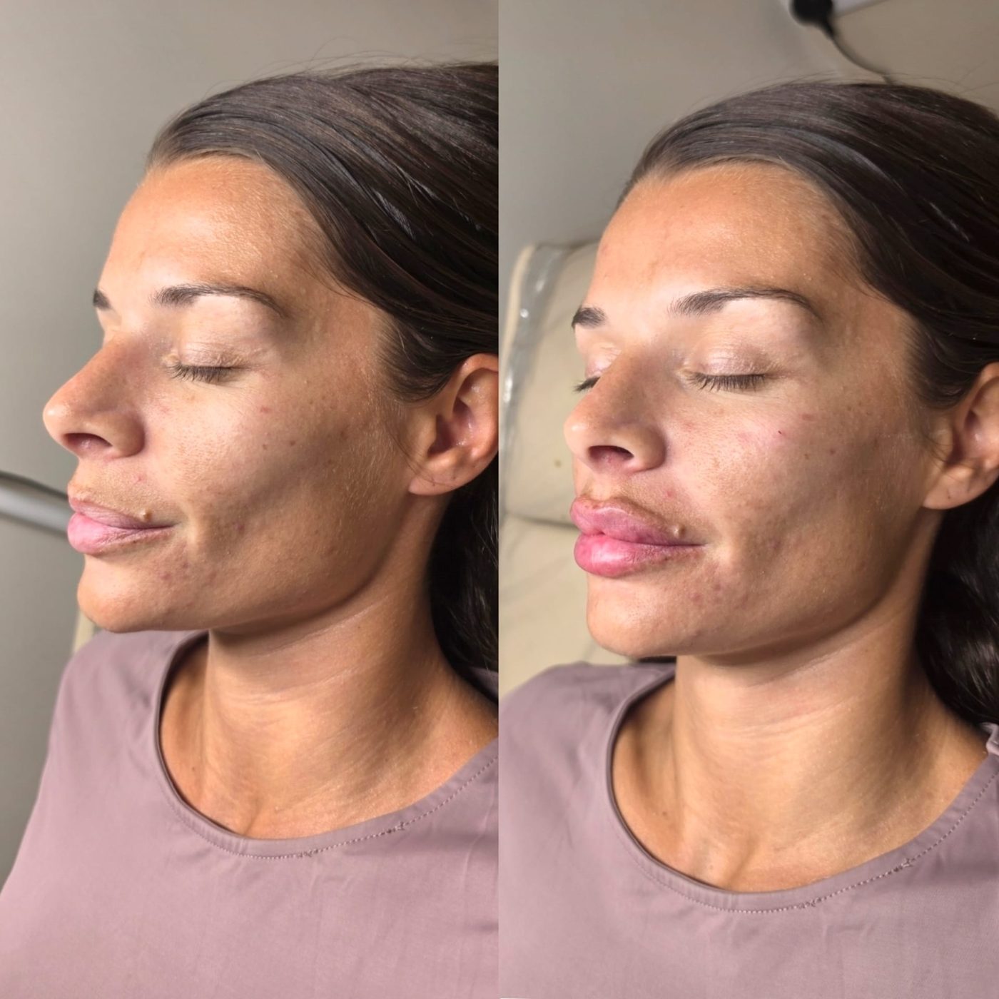 Lips before and after lip filler, side view