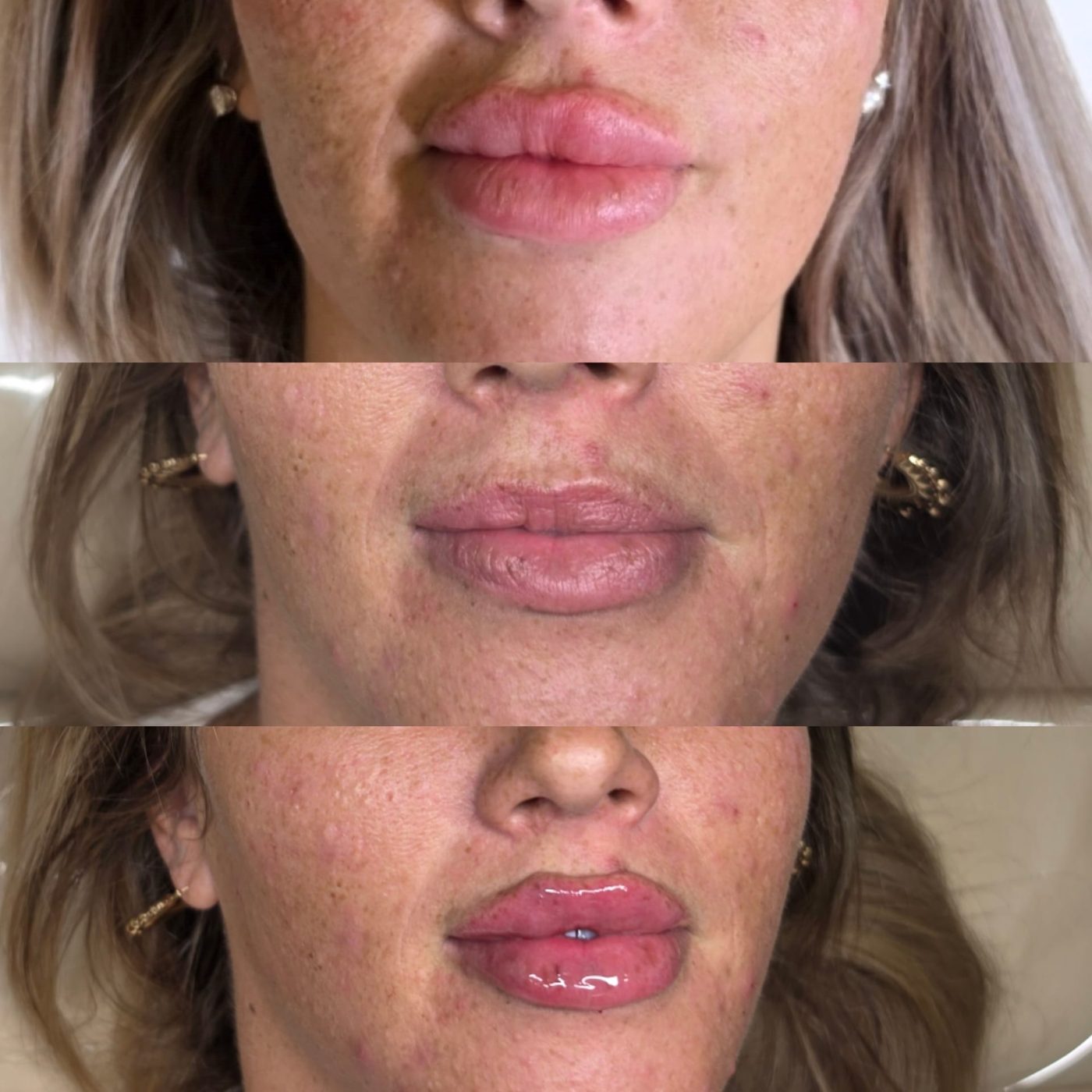 Lips at three stages of lip filler treatment